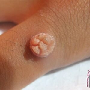 7 cara alami hilangkan kutil dengan bahan mudah didapat
