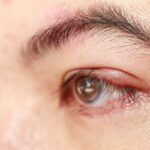 8 penyebab mata bintitan dan cara mengatasinya secara alami